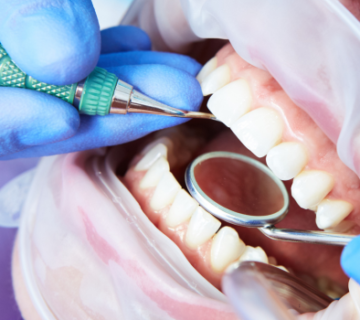 Tooth Replacement Implant