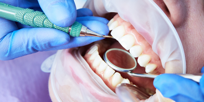 Tooth Replacement Implant