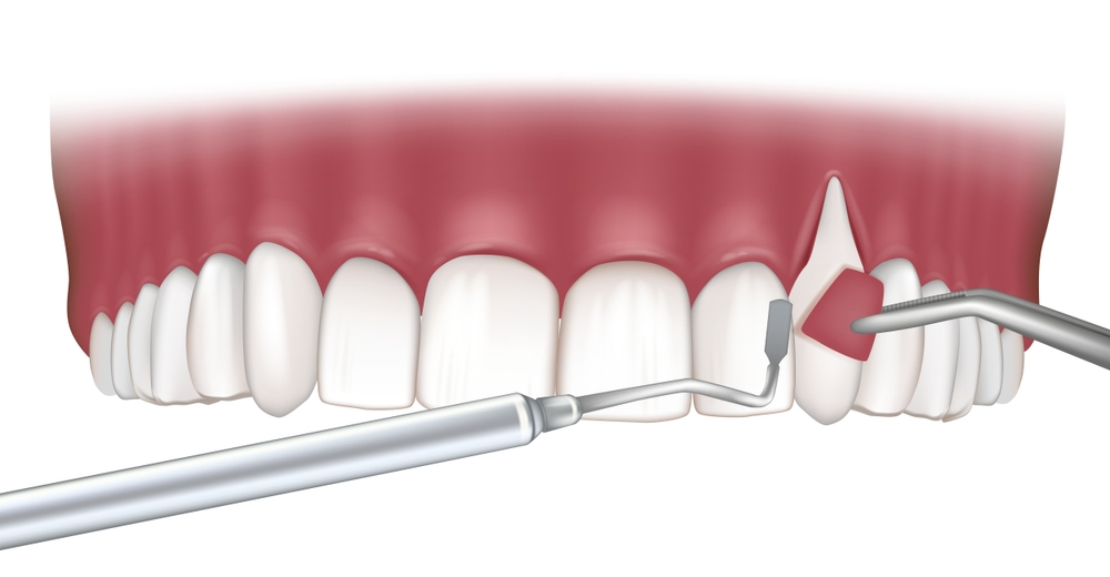 28ef38d466 Dental Gum Disease Treatment