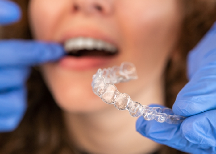 Best Invisalign Treatment In Ahmedabad