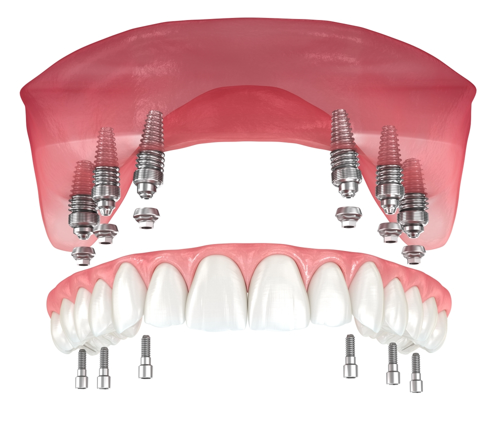 Dental Implant Dentures