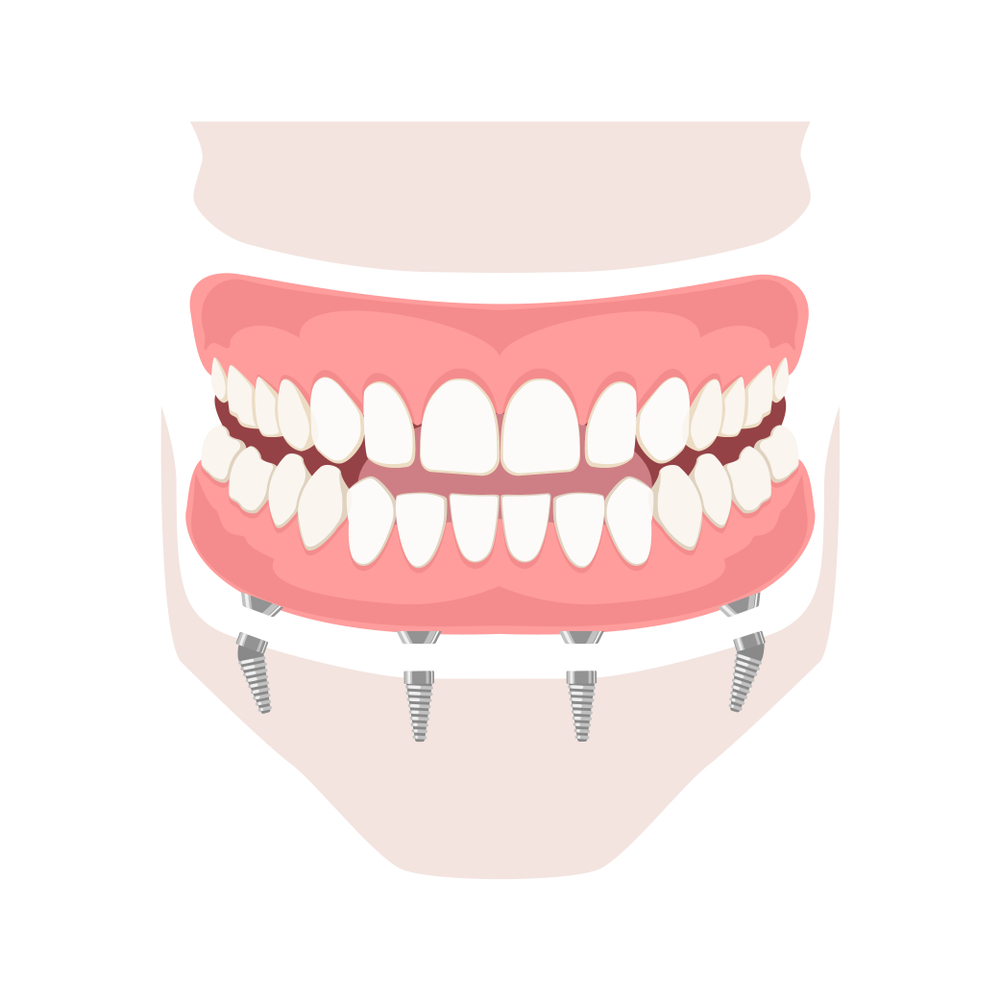full arch dental implant in ahmedabad