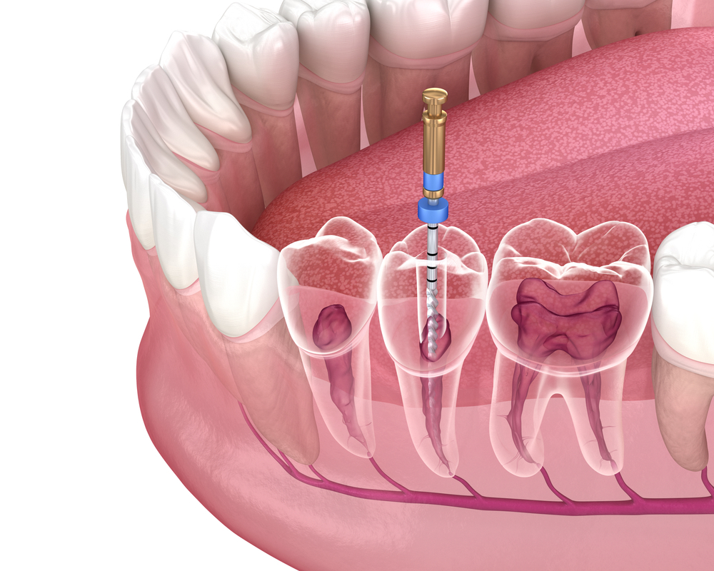 7d079d8606 root canal treatment in ahmedabad