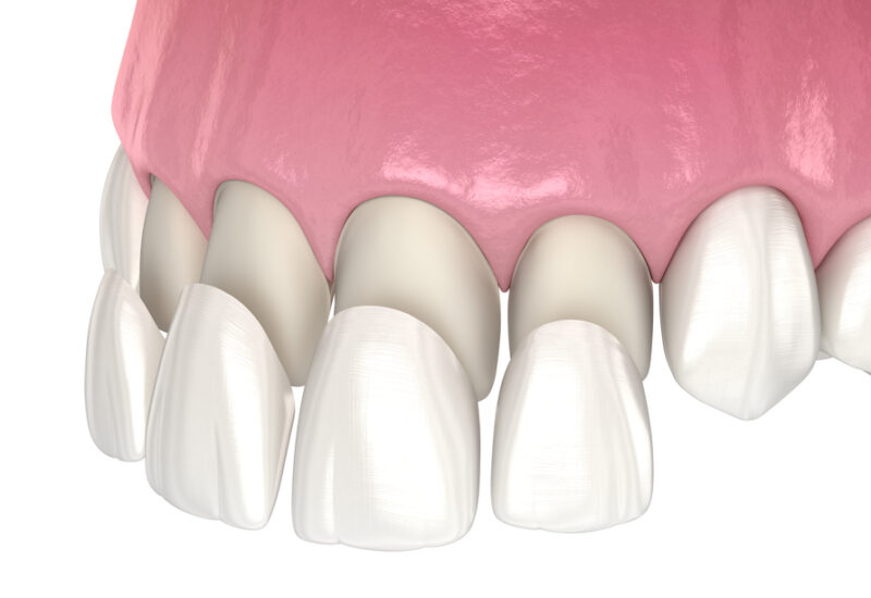 bfb5d6e914 Porcelain Dental Veneers