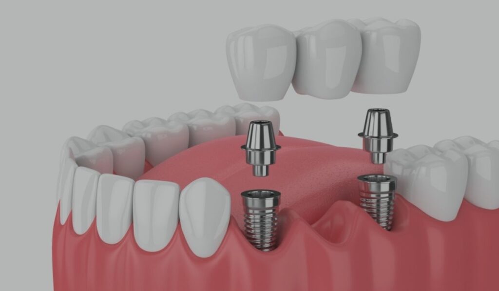 Best Dental Implants Ahmedabad
