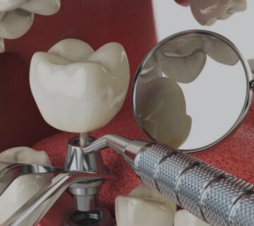Best Dental Implants Ahmedabad