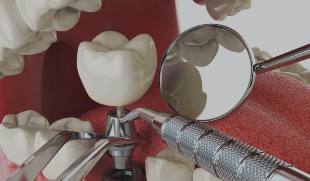 Best Dental Implants Ahmedabad