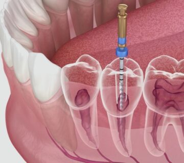 Root Canal Treatment In Ahmedabad