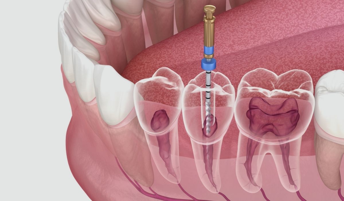 Root Canal Treatment In Ahmedabad