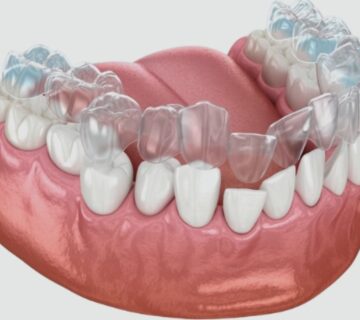 Invisalign Braces Treatment