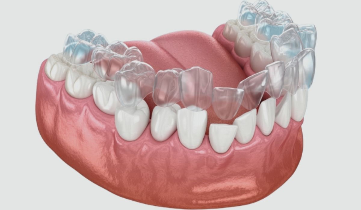 Invisalign Braces Treatment