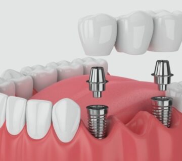 Dental Implants Treatment