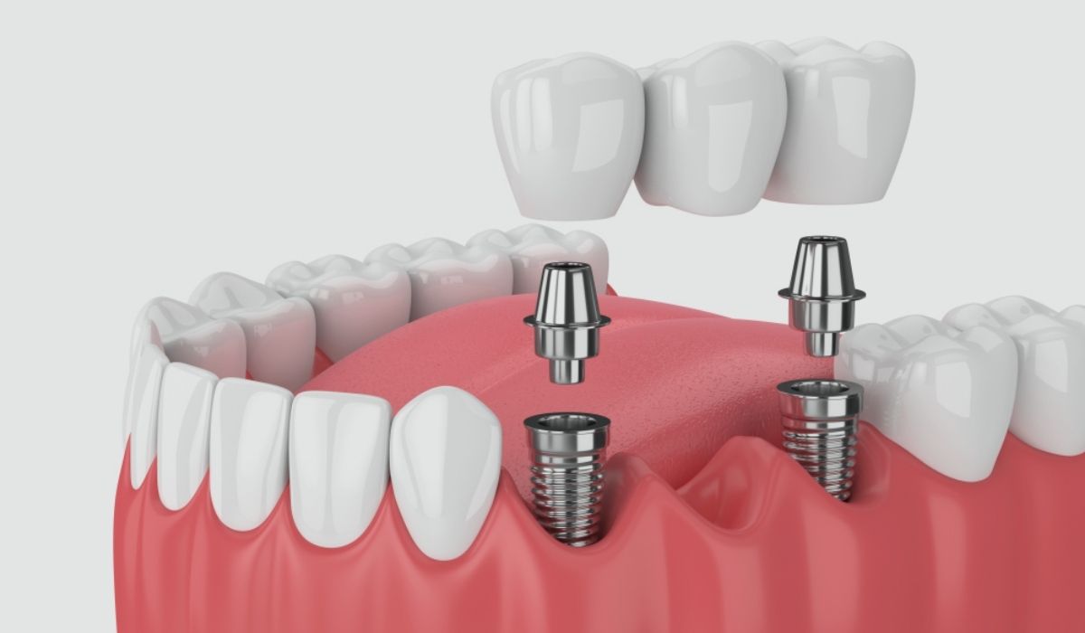 Dental Implants Treatment