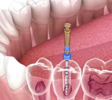 Painless Root Canal Treatment in Ahmedabad