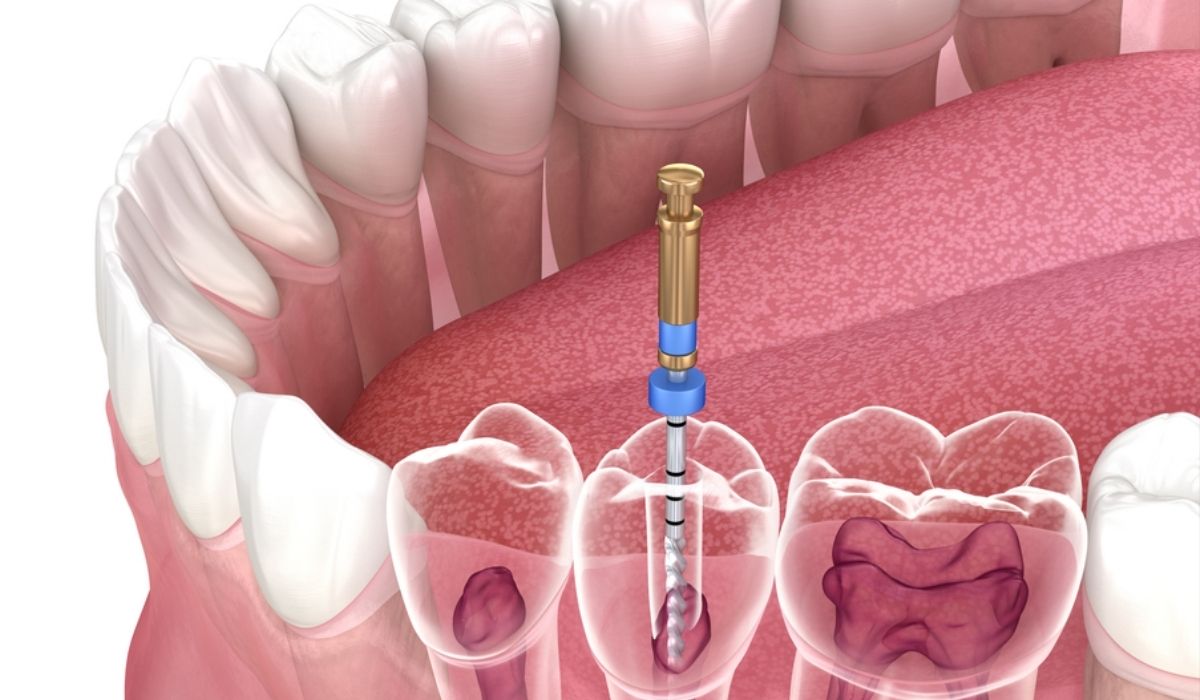 Painless Root Canal Treatment in Ahmedabad